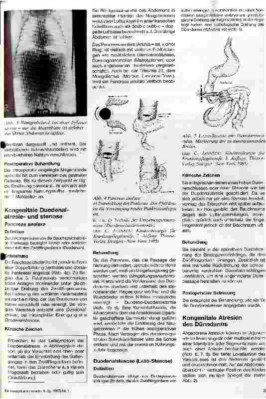 Vorschauseite 2: Kongenitale Atresien und Stenosen des Magen-Darmtraktes (ausgenommen Fehlbildungen der Speiseröhre)