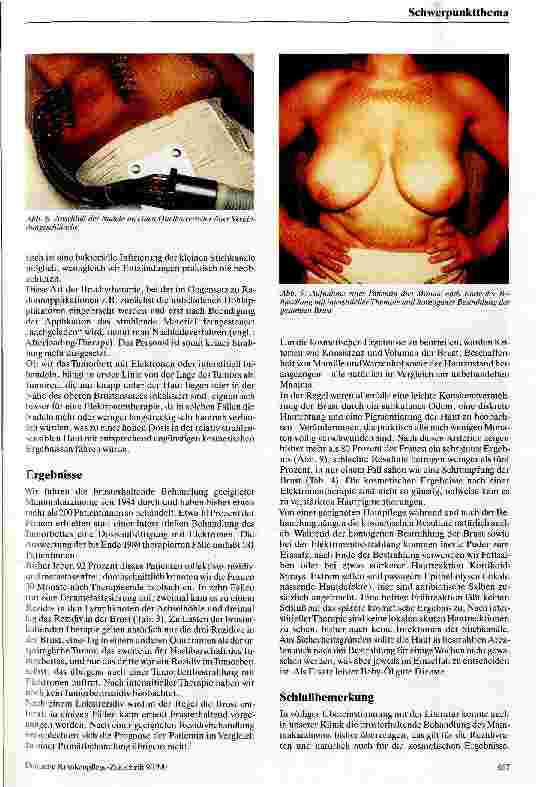 Vorschauseite 5: Die interstitielle Strahlentherapie bei der Behandlung des Mammakarzinoms