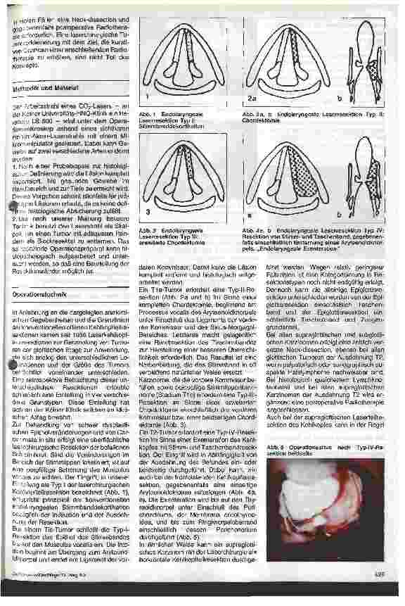 Vorschauseite 2: Endolaryngeale Laserchirurgie zur Behandlung von Kehlkopfkarzinomen Das aktuelle Kölner Konzept