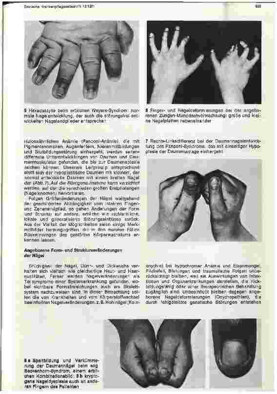 Vorschauseite 3: Entwicklungsstörungen der Fingerund Zehennägel