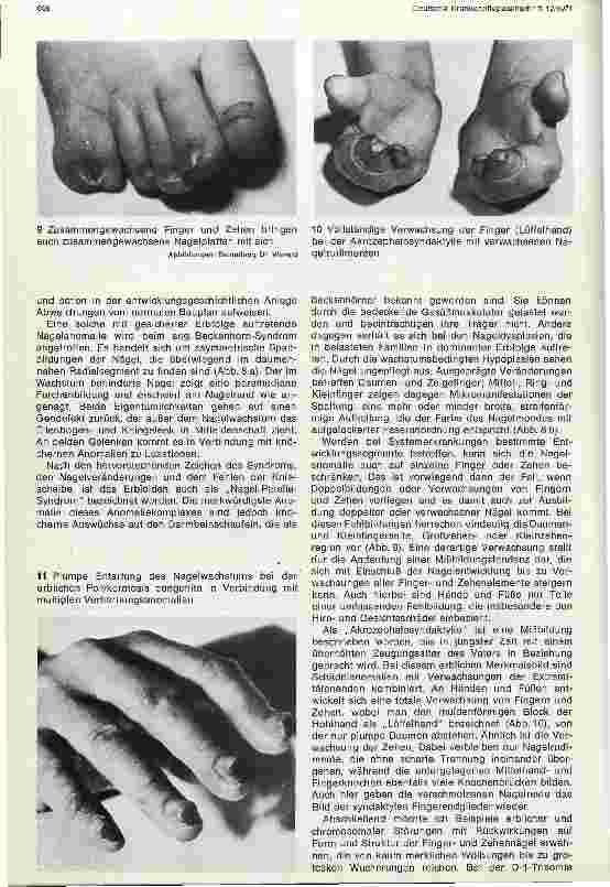 Vorschauseite 4: Entwicklungsstörungen der Fingerund Zehennägel