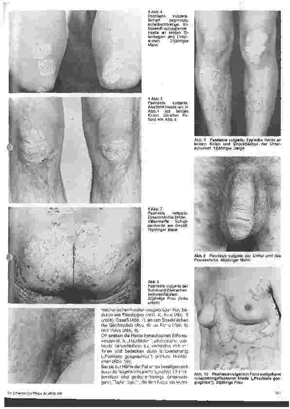 Vorschauseite 2: Hautärztliche Blick-Diagnose von Krankheiten: Die Schuppenflechte