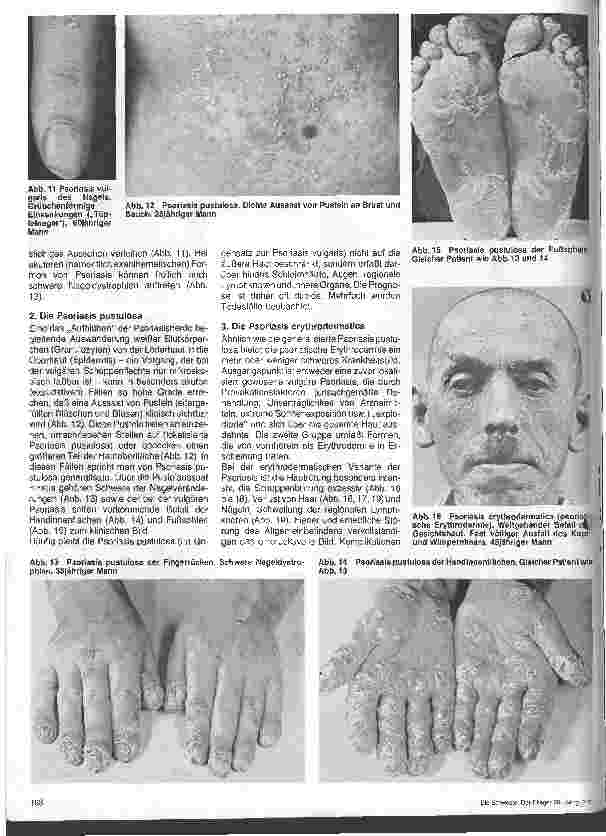 Vorschauseite 3: Hautärztliche Blick-Diagnose von Krankheiten: Die Schuppenflechte