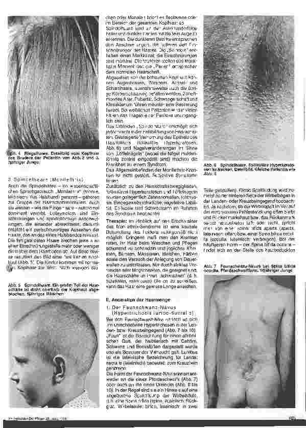 Vorschauseite 2: Hautärztliche Blick-Diagnose von Erbkrankheiten: Erbliche Störungen des Haarwachstums