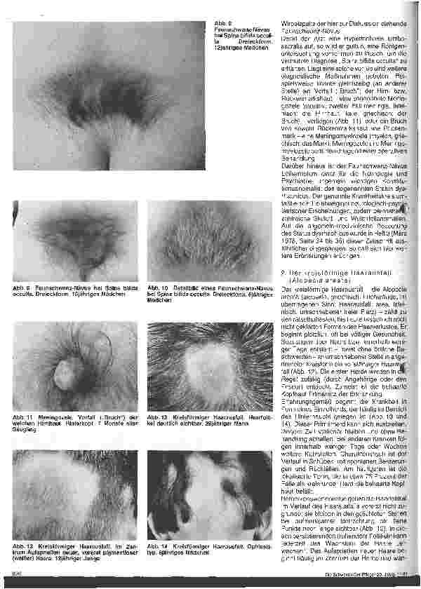 Vorschauseite 3: Hautärztliche Blick-Diagnose von Erbkrankheiten: Erbliche Störungen des Haarwachstums