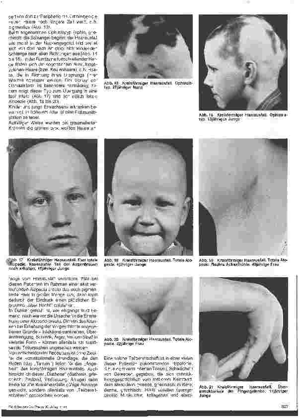 Vorschauseite 4: Hautärztliche Blick-Diagnose von Erbkrankheiten: Erbliche Störungen des Haarwachstums