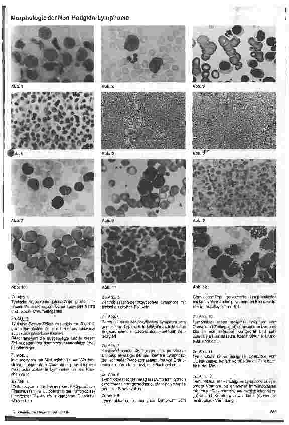 Vorschauseite 6: Die Therapie der Leukämien - Eine Standortorientierung 4. Teil (Schluß): die Non-Hodgkin-Lymphome