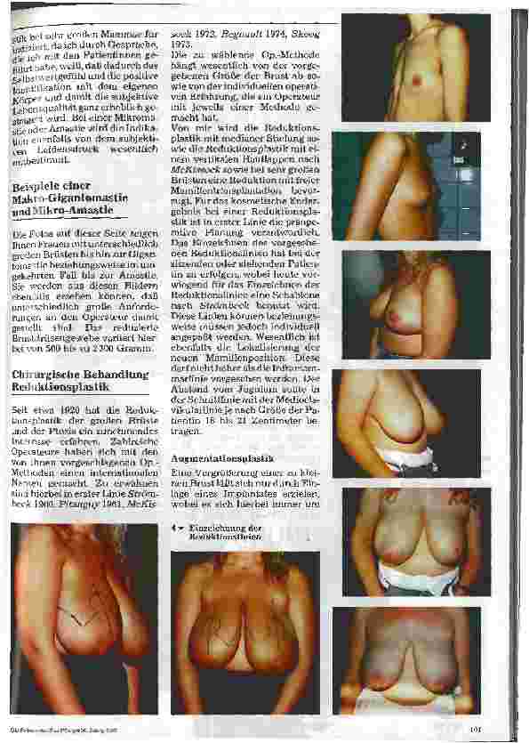 Vorschauseite 3: Reduktionsund Augmentationsplastiken der Mammae