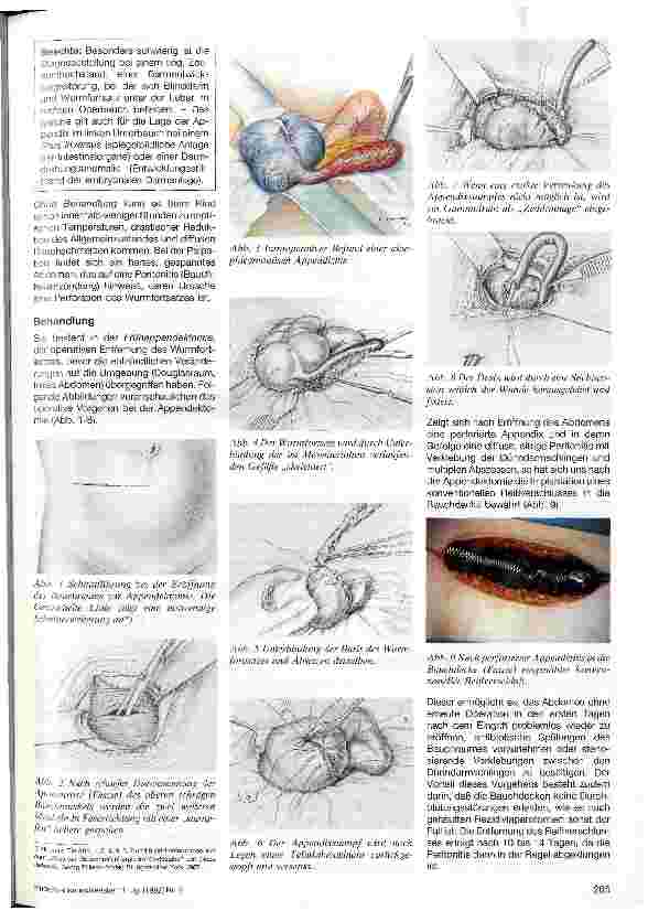 Vorschauseite 2: Appendizitis im Kindesalter