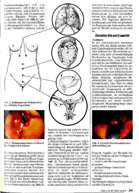 Vorschauseite 2: Krankheitsbilder und Behandlungsprinzipien der Endometriose
