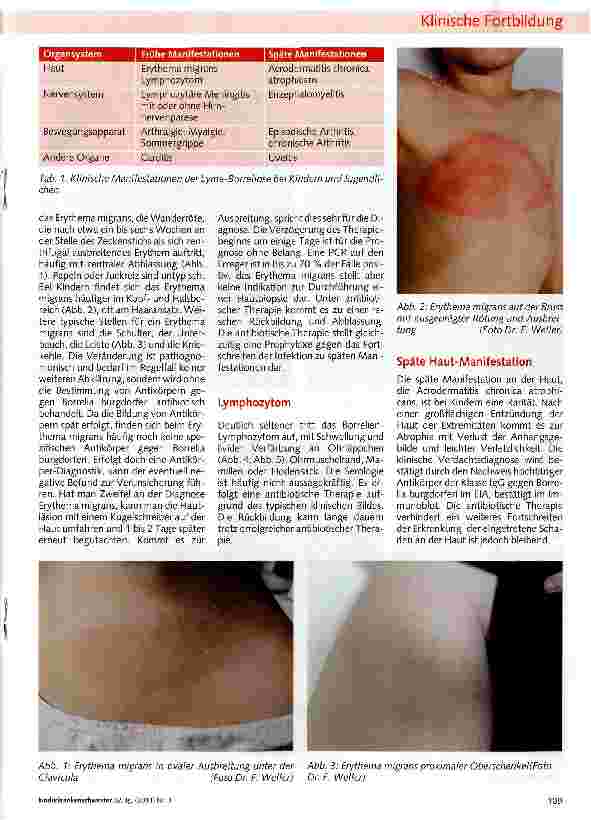Vorschauseite 2: Die Lyme-Borreliose bei Kindern und Jugendlichen