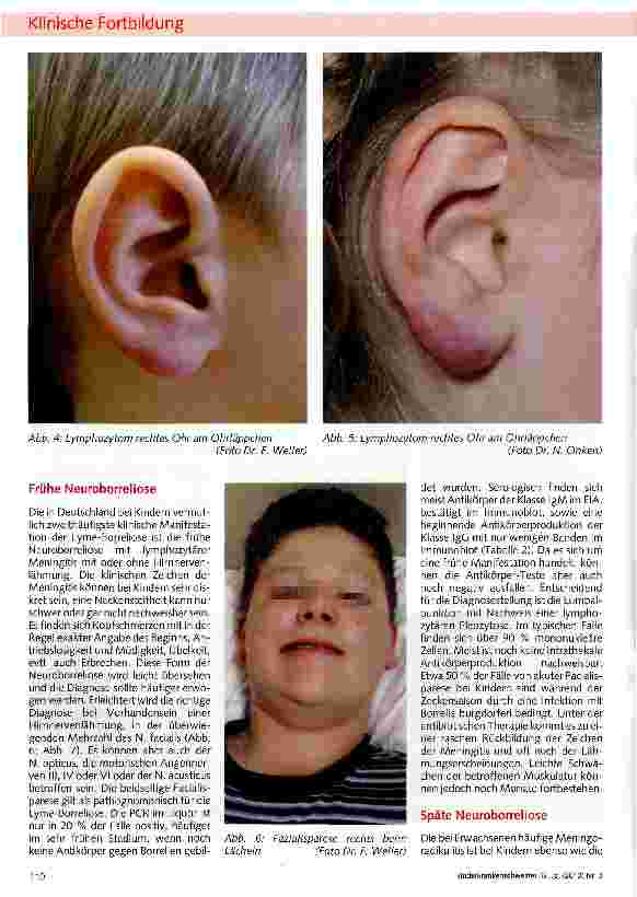 Vorschauseite 3: Die Lyme-Borreliose bei Kindern und Jugendlichen