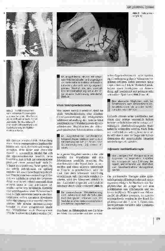 Vorschauseite 4: Akute Infektionen nach Osteosynthese