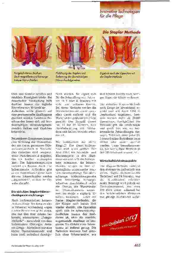 Vorschauseite 2: Stapler-Methodeentfernt Hämorrhoiden schnell und nahezu schmerzfrei