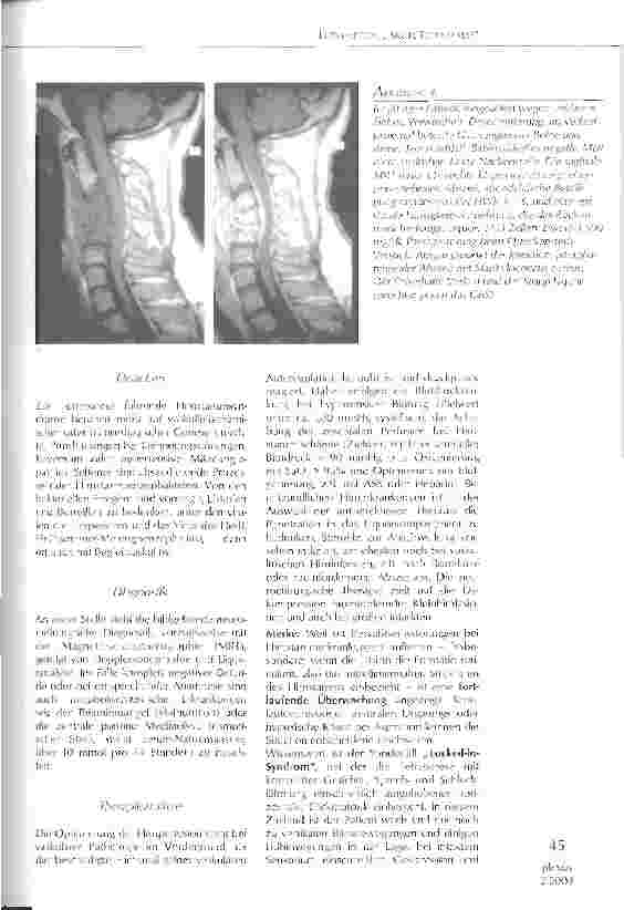 Vorschauseite 5: LEITSYMPTOM AKUTE TETRAPARESE