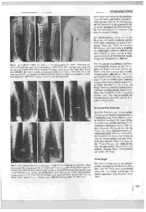Vorschauseite 2: Lösungsmöglichkeiten nach fehlgeschlagenen Osteosynthesen am Humerusschaft