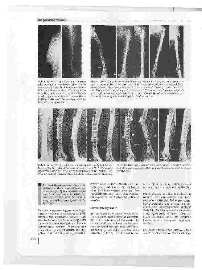 Vorschauseite 3: Lösungsmöglichkeiten nach fehlgeschlagenen Osteosynthesen am Humerusschaft