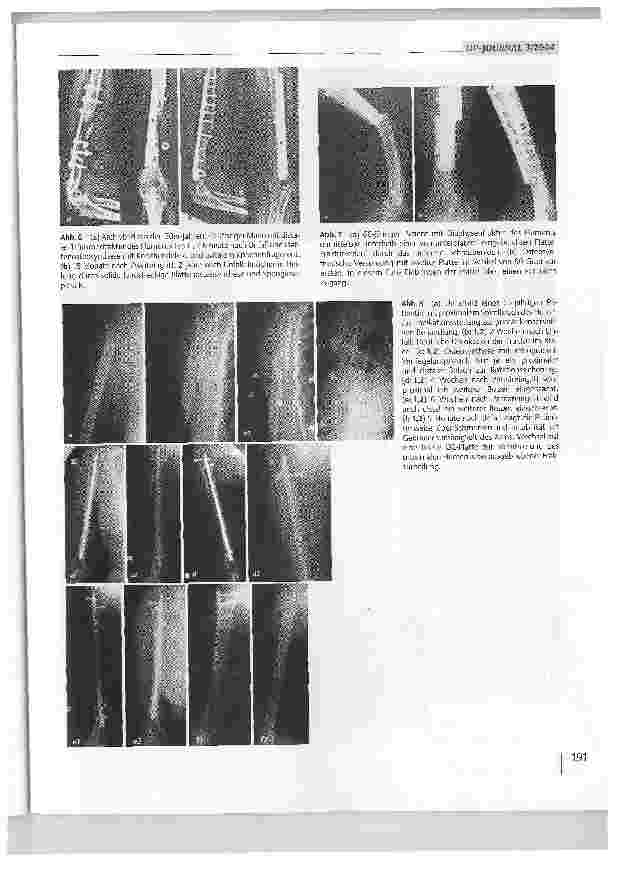 Vorschauseite 4: Lösungsmöglichkeiten nach fehlgeschlagenen Osteosynthesen am Humerusschaft