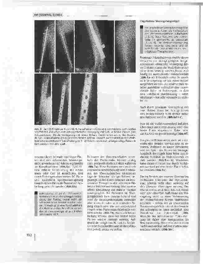 Vorschauseite 5: Lösungsmöglichkeiten nach fehlgeschlagenen Osteosynthesen am Humerusschaft