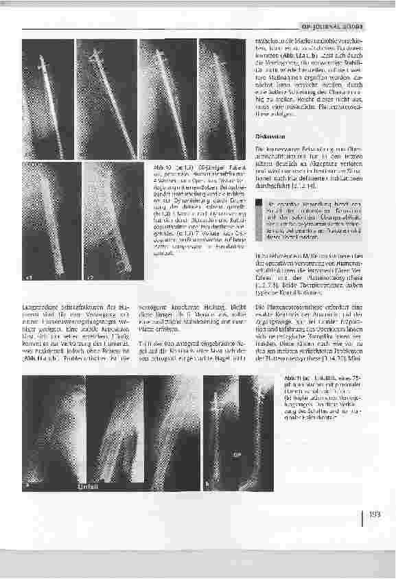 Vorschauseite 6: Lösungsmöglichkeiten nach fehlgeschlagenen Osteosynthesen am Humerusschaft