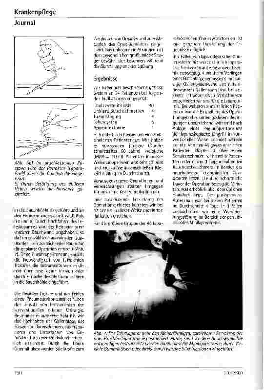 Vorschauseite 4: Gaslose laparoskopische Cholecystektomie