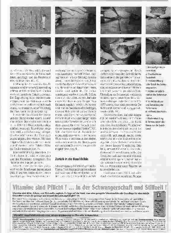 Vorschauseite 2: Misgav-Ladach-Sectioeine neue Methode