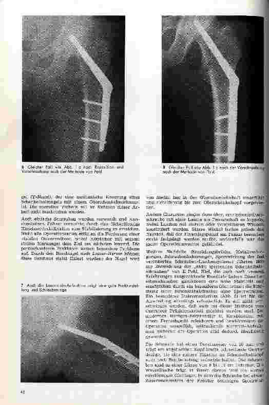 Vorschauseite 5: Behandlungsmöglichkeiten bei Schenkelhalsbrüchen