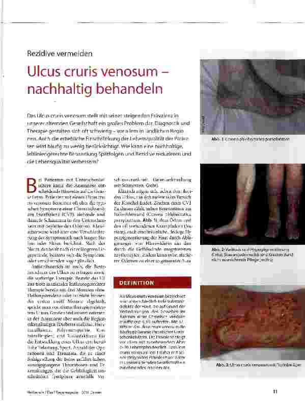 Vorschauseite 1: Ulcus cruris venosum -nachhaltig behandeln