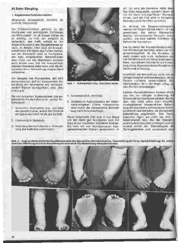 Vorschauseite 3: Moderne Entwicklung in der Orthopädie 1. Teil: Gipsanwendung in der Orthopädie