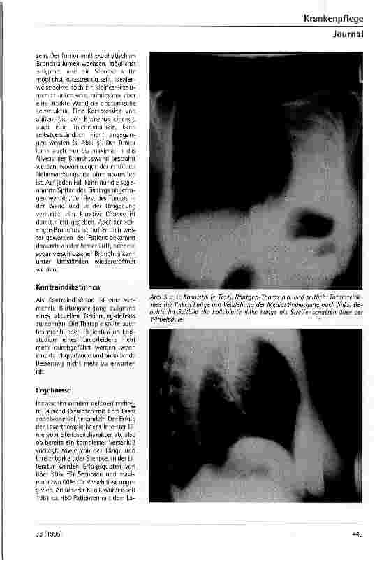 Vorschauseite 4: Möglichkeiten der endobronchialen Lasertherapie