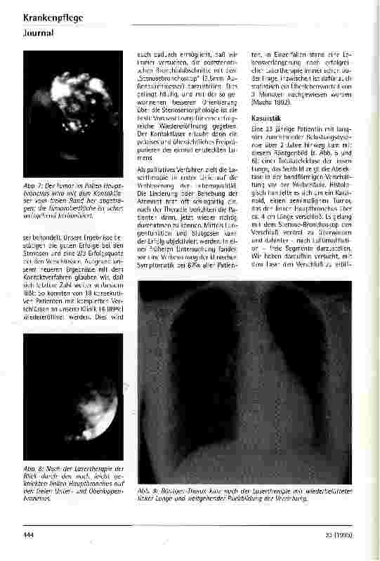 Vorschauseite 5: Möglichkeiten der endobronchialen Lasertherapie