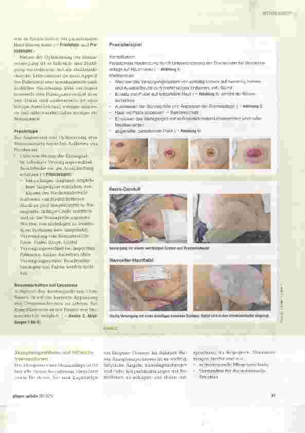Vorschauseite 3: Stoma - Beratung und Versorgung