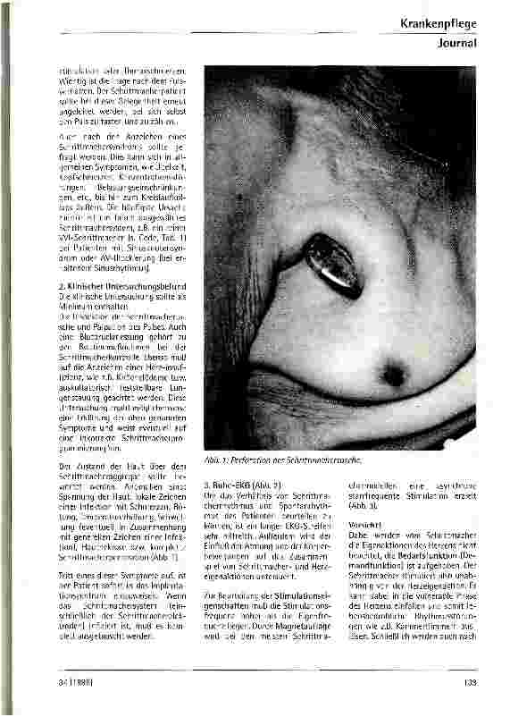 Vorschauseite 4: Nachsorge und Funktionskontrolle bei Herzschrittmacherträgern
