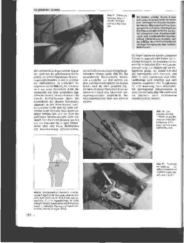 Vorschauseite 5: Die hohe öffnende Tibiaosteotomie