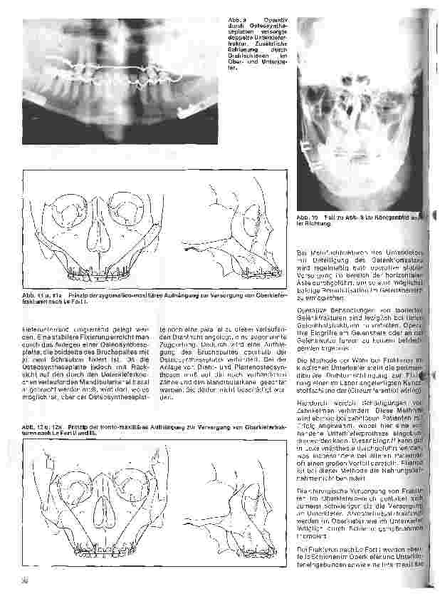 Vorschauseite 4: Zahn-Mundund Kieferchirurgie 9. Folge: Traumatologie II Therapie der Kieferbrüche