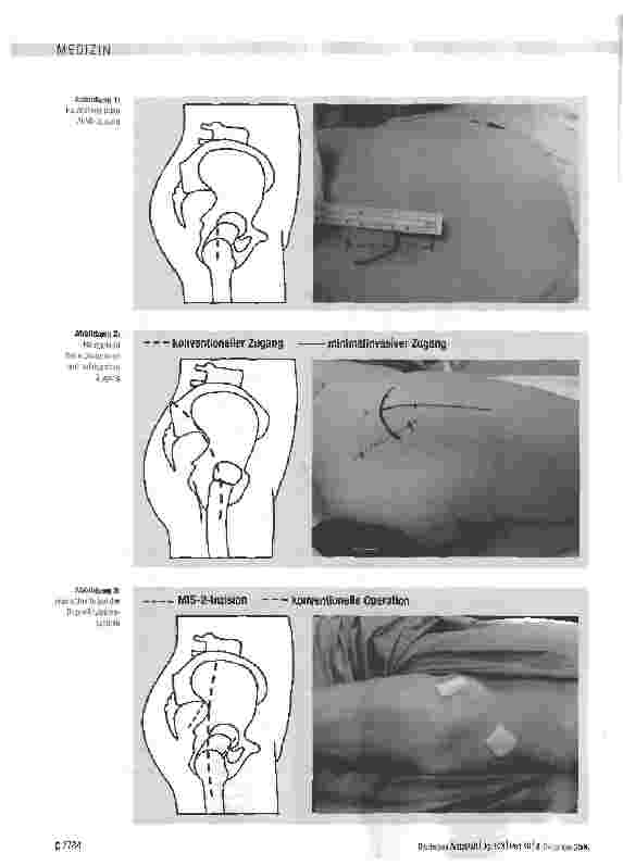 Vorschauseite 3: Minimalinvasive Hüftendoprothetik