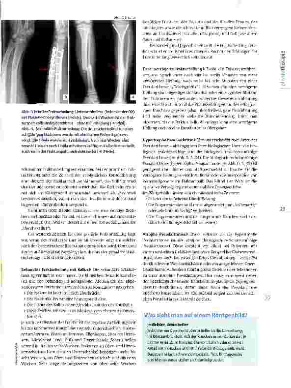 Vorschauseite 2: Röntgenbilder interpretieren: Frakturheilung Diagnostik in Schwarz-Weiß