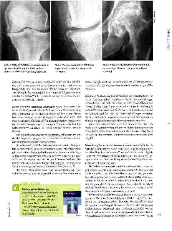 Vorschauseite 2: Röntgenbilder interpretieren: ArthroseVon Geröllzysten und Knorpelglatzen