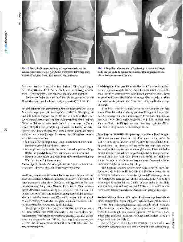 Vorschauseite 3: Röntgenbilder interpretieren: ArthroseVon Geröllzysten und Knorpelglatzen