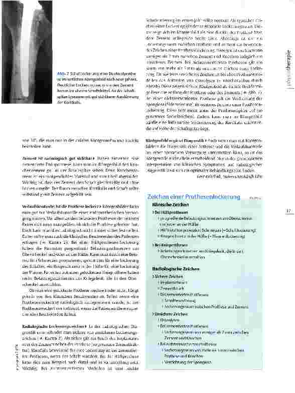 Vorschauseite 4: Röntgenbilder interpretieren: ArthroseVon Geröllzysten und Knorpelglatzen