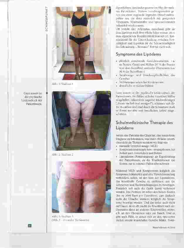 Vorschauseite 3: Lipödem und Lipolymphödem Ganzheitliche Therapieansätze
