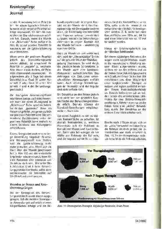 Vorschauseite 5: Über die Anwendung gepulster elektrischer Stimulation bei der Therapie von Dekubitalulcera