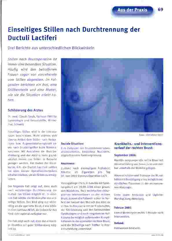 Vorschauseite 1: Einseitiges Stillen nach Durchtrennung der Ductuli Lactiferi