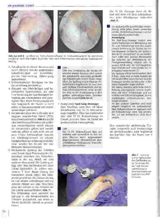 Vorschauseite 5: Die arthroskopische Behandlung des frühen Gelenkinfektes
