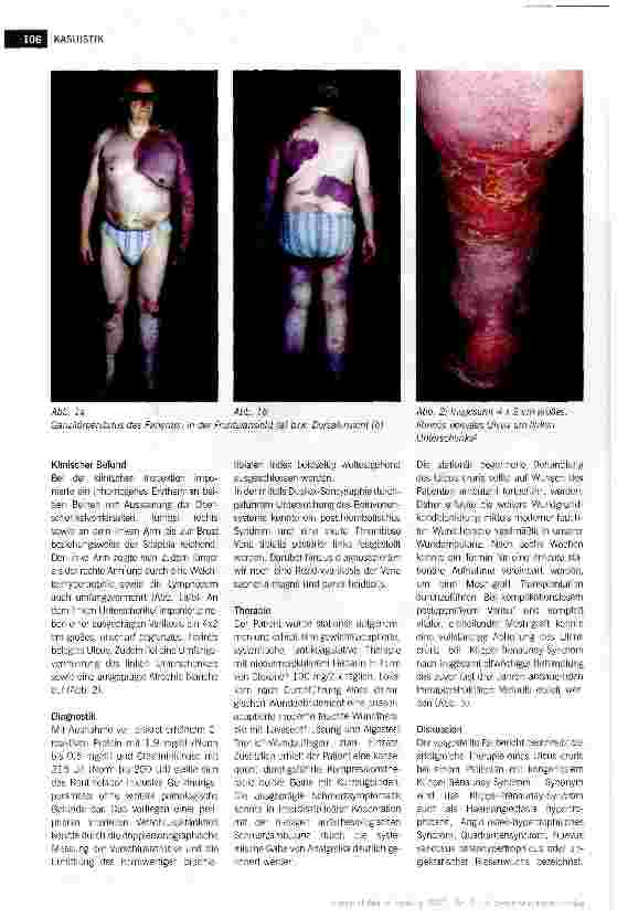Vorschauseite 2: UIcus cruris bei Klippel-Trenaunay-Syndrom