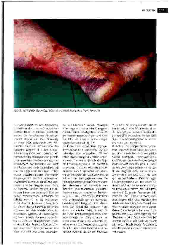 Vorschauseite 3: UIcus cruris bei Klippel-Trenaunay-Syndrom