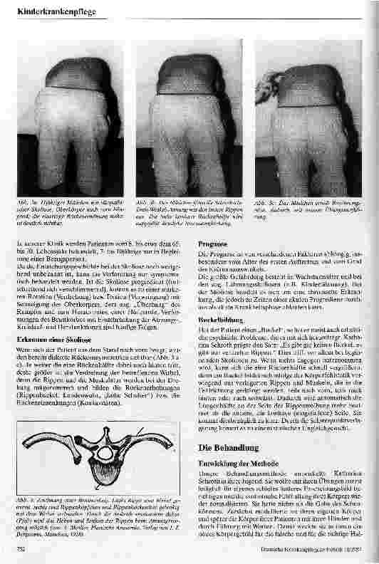 Vorschauseite 2: Die dreidemensionale Skoliosebehandlung nach Schroth Eine konservative Behandlungsweise der Rückgratverkrümmung