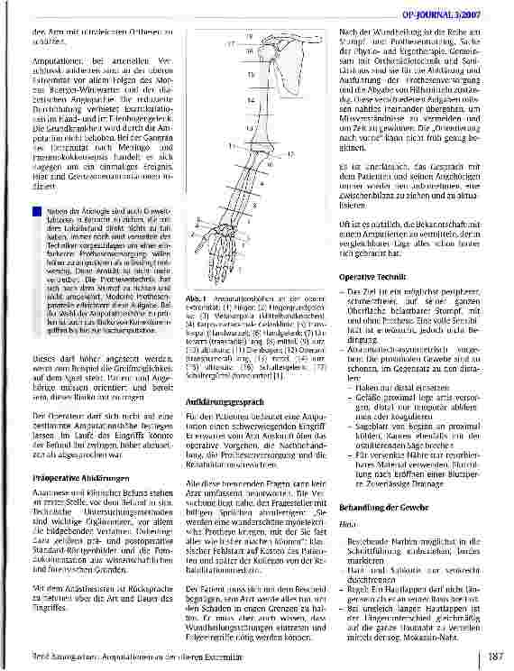 Vorschauseite 2: Amputationen an der oberen Extremität