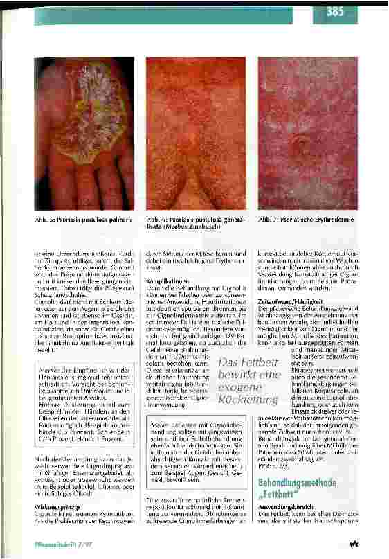 Vorschauseite 4: Die Schuppenflechte hat viele Gesichter Pflegestandards und Behandlungsmethoden in der Dermatologie Teil 2