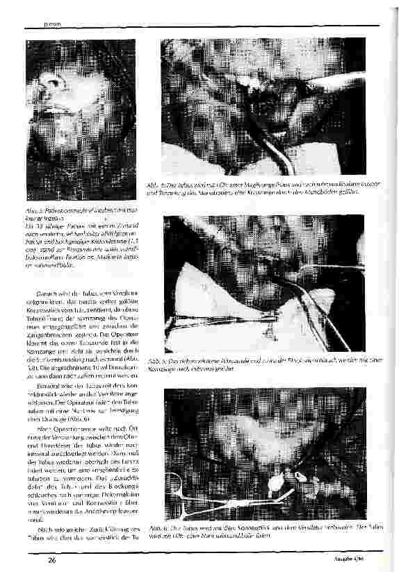 Vorschauseite 2: Die submandibulär-endotracheale Intubation -eine temporäre Alternative zur Tracheotomie